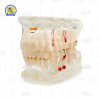 Tipodonto con Patologias: diente perdido, implante y caries Zomy